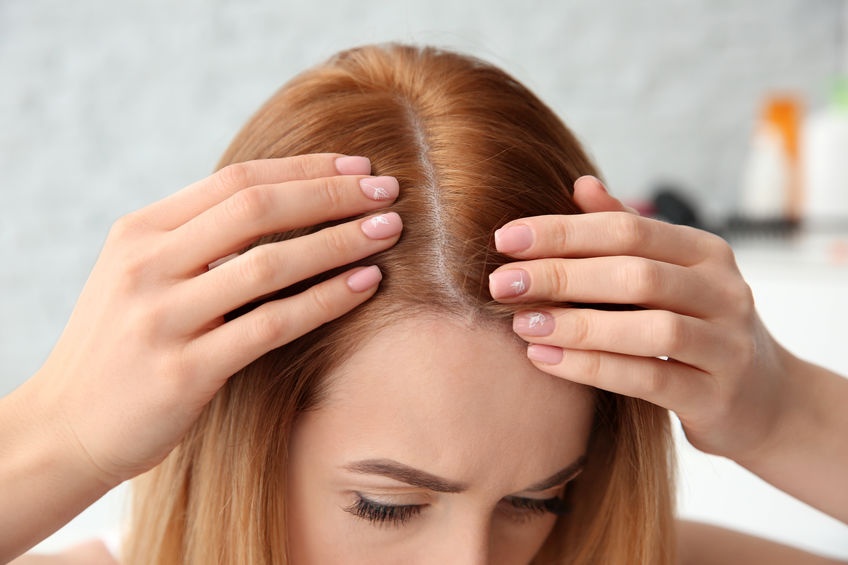 درمان ریزش مو بر اثر تغییرات هورمونی